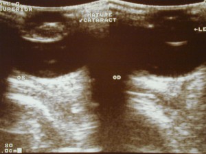 UltraSound1 Cataract on the left, normal clear lens on the right