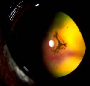 incipient cataract Insignificant incipient cataract